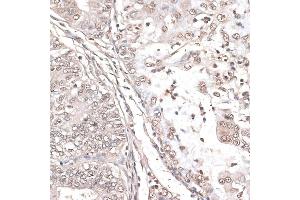 Immunohistochemistry of paraffin-embedded human endometrium cancer using MEF2C antibody (ABIN6132345, ABIN6143716, ABIN6143717 and ABIN6215998) at dilution of 1:100 (40x lens).