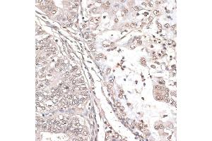 Immunohistochemistry of paraffin-embedded human endometrium cancer using MEF2C antibody (ABIN6132345, ABIN6143716, ABIN6143717 and ABIN6215998) at dilution of 1:100 (40x lens). (MEF2C anticorps  (AA 170-380))