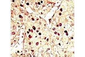 IHC analysis of FFPE human hepatocarcinoma tissue stained with the Aurora B antibody (Aurora Kinase B anticorps  (AA 6-35))