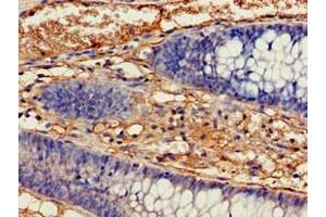 Immunohistochemistry of paraffin-embedded human colon cancer using ABIN7157120 at dilution of 1:100