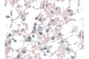 Detection of BANF1 in Human Glioma Tissue using Polyclonal Antibody to Barrier To Autointegration Factor 1 (BANF1)