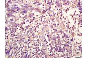 Formalin-fixed and paraffin embedded human lung carcinoma labeled with Anti-phospho-ERK1(Thr202/Tyr204) +ERK2(Thr183/Tyr185) Polyclonal Antibody, Unconjugated (ABIN732458) at 1:200 followed by conjugation to the secondary antibody and DAB staining (ERK1/2 anticorps  (pThr183, pTyr185))