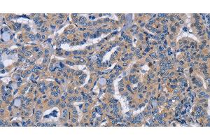Immunohistochemistry of paraffin-embedded Human thyroid cancer tissue using NCR2 Polyclonal Antibody at dilution 1:60 (NKp44/NCR2 anticorps)