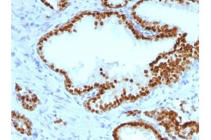 Formalin-fixed, paraffin-embedded human Prostate Carcinoma stained with FOXA1 Monoclonal Antibody (FOXA1/1241). (FOXA1 anticorps  (AA 372-472))