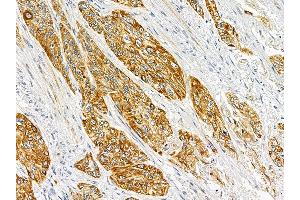 ABIN6262367 and ABIN6278302 at 1/100 staining human esophageal cancer by IHC-P. (HRH2 anticorps  (Internal Region))