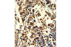 Formalin-fixed and paraffin-embedded human lung carcinoma reacted with SOD3 Antibody (N-term), which was peroxidase-conjugated to the secondary antibody, followed by DAB staining. (SOD3 anticorps  (N-Term))
