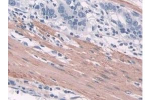 Detection of TAGLN in Human Stomach cancer Tissue using Polyclonal Antibody to Transgelin (TAGLN)