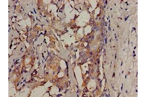 Immunohistochemistry analysis of human breast cancer using ABIN7174064 at dilution of 1:100
