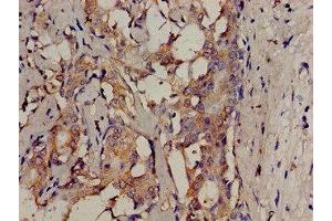 Immunohistochemistry analysis of human breast cancer using ABIN7174064 at dilution of 1:100 (SRMS anticorps  (AA 19-155))