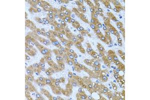 Immunohistochemistry of paraffin-embedded human liver damage using CPM antibody (ABIN6128978, ABIN6138956, ABIN6138957 and ABIN6222238) at dilution of 1:100 (40x lens).