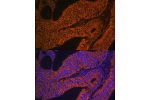 Immunofluorescence analysis of human colon carcinoma using RB antibody (ABIN6128601, ABIN6146597, ABIN6146598 and ABIN6223325) at dilution of 1:100. (RAB5B anticorps  (AA 1-215))