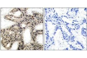 Immunohistochemical analysis of paraffin-embedded human breast carcinoma tissue using 4E-BP1(Phospho-Thr45) Antibody(left) or the same antibody preincubated with blocking peptide(right). (eIF4EBP1 anticorps  (pThr45))