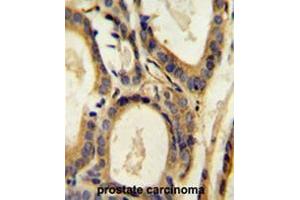 CCL4 Antibody (Center) immunohistochemistry analysis in formalin fixed and paraffin embedded human prostate carcinoma followed by peroxidase conjugation of the secondary antibody and DAB staining. (CCL4 anticorps  (Middle Region))