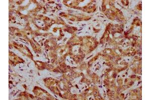 IHC image of ABIN7165570 diluted at 1:400 and staining in paraffin-embedded human liver cancer performed on a Leica BondTM system. (FAM83G anticorps  (AA 464-615))