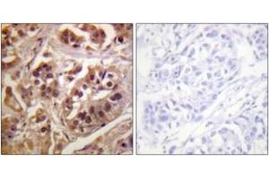 Immunohistochemistry analysis of paraffin-embedded human lung carcinoma tissue, using IKK-gamma (Ab-31) Antibody. (IKBKG anticorps  (AA 16-65))