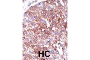Formalin-fixed and paraffin-embedded human hepatocellular carcinoma tissue reacted with SMURF1 polyclonal antibody  , which was peroxidase-conjugated to the secondary antibody, followed by DAB staining. (SMURF1 anticorps  (C-Term))
