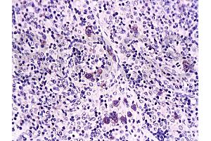 Formalin-fixed and paraffin embedded rat transplant lymphoma labeled with Anti-Caspase-1 Polyclonal Antibody, Unconjugated (ABIN725780) at 1:200 followed by conjugation to the secondary antibody and DAB staining (Caspase 1 (p10) anticorps  (AA 320-404))