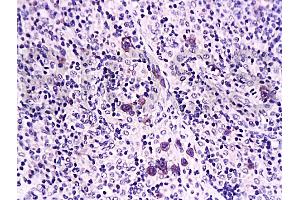 Formalin-fixed and paraffin embedded rat transplant lymphoma labeled with Anti-Caspase-1 Polyclonal Antibody, Unconjugated (ABIN725780) at 1:200 followed by conjugation to the secondary antibody and DAB staining (Caspase 1 (p10) anticorps  (AA 320-404))