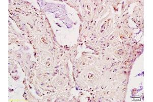 Formalin-fixed and paraffin embedded human rectal carcinoma labeled Anti-LDL receptor Polyclonal Antibody, Unconjugated  at 1:200, followed by conjugation to the secondary antibody and DAB staining