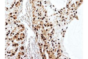 IHC-P Image Immunohistochemical analysis of paraffin-embedded A549 xenograft, using SET antibody, isoform 2-specifc , at 1:100 dilution. (SET/TAF-I anticorps  (N-Term))