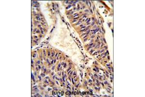 Formalin-fixed and paraffin-embedded human lung carcinoma reacted with ALG14 Antibody , which was peroxidase-conjugated to the secondary antibody, followed by DAB staining. (ALG14 anticorps  (AA 67-93))