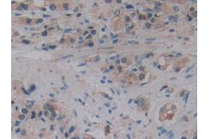 DAB staining on IHC-P; Samples: Human Prostate cancer Tissue (ALOX15B anticorps  (AA 253-490))