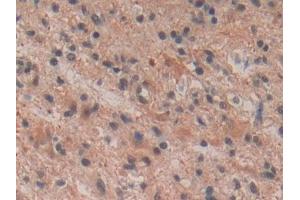 DAB staining on IHC-P; Samples: Human Glioma Tissue (Tachykinin 3 anticorps  (AA 23-121))