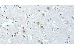 Immunohistochemistry of paraffin-embedded Human brain tissue using ACLY Polyclonal Antibody at dilution 1:40 (ACLY anticorps)