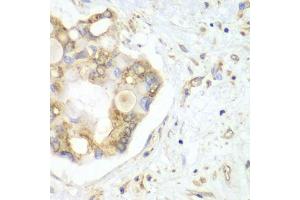 Immunohistochemistry of paraffin-embedded human liver cancer using VTI1B antibody. (VTI1B anticorps)