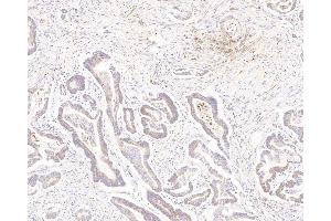 Immunohistochemistry analysis of paraffin-embedded human colon cancer using MMP2 Polyclonal Antibody at dilution of 1:500. (MMP2 anticorps)