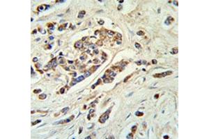 ABCC11 antibody IHC analysis in formalin fixed and paraffin embedded breast carcinoma. (ABCC11 anticorps  (AA 343-372))