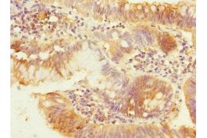Immunohistochemistry of paraffin-embedded human colon cancer using ABIN7162961 at dilution of 1:100 (PEX19 anticorps  (AA 1-299))