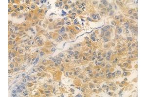 ABIN7095030 and ABIN7099086 at 1/100 staining human lung squamous cell carcinoma by IHC-P. (TMEM199 anticorps)