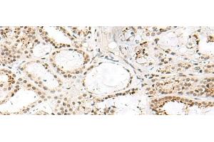 Immunohistochemistry of paraffin-embedded Human thyroid cancer tissue using FKBP5 Polyclonal Antibody at dilution of 1:50(x200)