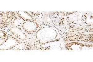 Immunohistochemistry of paraffin-embedded Human thyroid cancer tissue using FKBP5 Polyclonal Antibody at dilution of 1:50(x200) (FKBP5 anticorps)