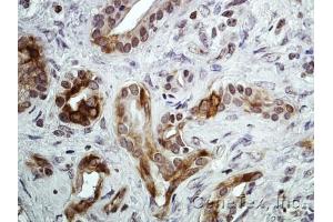 IHC-P Image Immunohistochemical analysis of paraffin-embedded Human pancreatic tumor, using CXCR7, antibody at 1:100 dilution.
