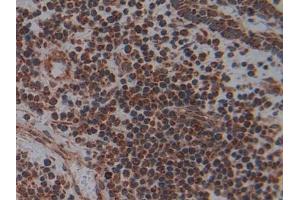 Detection of PLAP in Human Skin cancer Tissue using Polyclonal Antibody to Phospholipase A2 Activating Protein (PLAP)