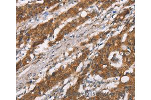 Immunohistochemistry of Human thyroid cancer using DSC2 Polyclonal Antibody at dilution of 1:35 (Desmocollin 2 anticorps)