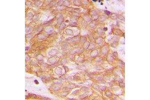 Immunohistochemical analysis of BEGAIN staining in human breast cancer formalin fixed paraffin embedded tissue section. (BEGAIN anticorps  (C-Term))