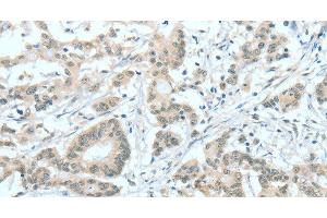 Immunohistochemistry of paraffin-embedded Human colon cancer tissue using ASH2L Polyclonal Antibody at dilution 1:60 (ASH2L anticorps)