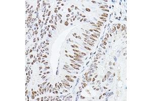Immunohistochemistry of paraffin-embedded human colon carcinoma using YE Rabbit pAb (ABIN6130808, ABIN6150331, ABIN6150332 and ABIN6221925) at dilution of 1:100 (40x lens). (GAS41 anticorps  (AA 1-227))