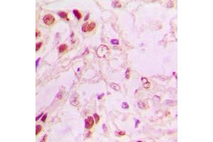 Immunohistochemical analysis of MDM2 staining in human lung cancer formalin fixed paraffin embedded tissue section.