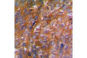 Immunohistochemical analysis of c-CBL (pY774) staining in human breast cancer formalin fixed paraffin embedded tissue section.