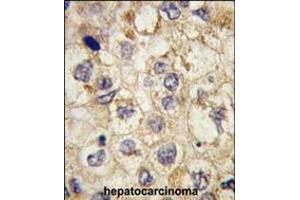 Formalin-fixed and paraffin-embedded human hepatocarcinoma tissue reacted with SSR1 antibody , which was peroxidase-conjugated to the secondary antibody, followed by DAB staining. (SSR1 anticorps  (N-Term))