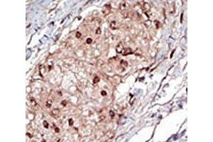 IHC analysis of FFPE human hepatocarcinoma tissue stained with the SPHK1 antibody (SPHK1 anticorps  (AA 286-315))