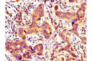 IHC image of ABIN7145294 diluted at 1:400 and staining in paraffin-embedded human pancreatic cancer performed on a Leica BondTM system.