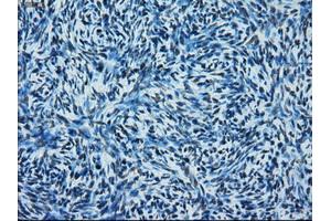 Immunohistochemical staining of paraffin-embedded Adenocarcinoma of colon tissue using anti-ERCC1 mouse monoclonal antibody. (ERCC1 anticorps)