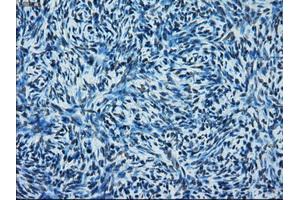 Immunohistochemical staining of paraffin-embedded Adenocarcinoma of colon tissue using anti-ERCC1 mouse monoclonal antibody. (ERCC1 anticorps)