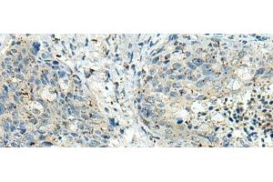 Immunohistochemistry of paraffin-embedded Human cervical cancer tissue using PAK1IP1 Polyclonal Antibody at dilution of 1:120(x200) (PAK1IP1 anticorps)