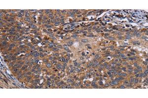 Immunohistochemistry of paraffin-embedded Human cervical cancer tissue using LRRC15 Polyclonal Antibody at dilution 1:60 (LRRC15 anticorps)